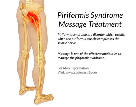 Piriformis Syndrome Massage Treatment Piriformis Muscle Massage