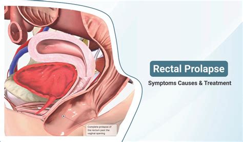 rectal prolapse symptoms causes diagnosing and treatment