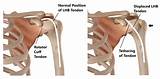 Learn about shoulder anatomy, muscles in the shoulder joints and watch anatomy of the the subacromial bursa lies on the top portion of the supraspinatus tendon. Biceps Tendon Injuries - My Family Physio