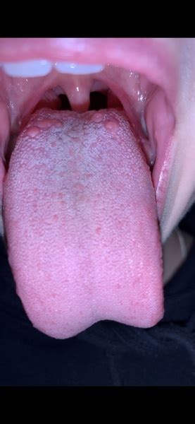 Help What Are These Tongue Spots Pic Included Mumsnet