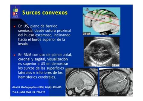 Surcos Convexos En Us P