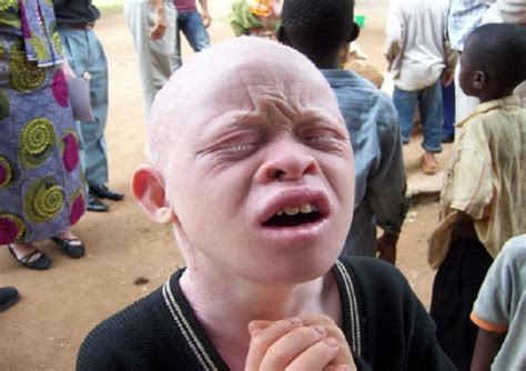 Malawi Gives Personal Security Alarms To Albinos In Hopes Of Battling Persecution Face2face Africa