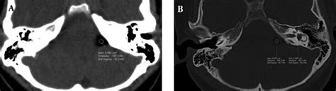Axial Ct Images Show Lipoma As A Hypodense Lesion In A The Left