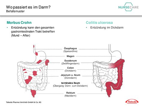 Grundlagen der CED | www.takeda-gastroenterologie.de/nursecare