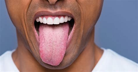 Surprising Cause Of Those Mysterious Black Spots On Your Tongue