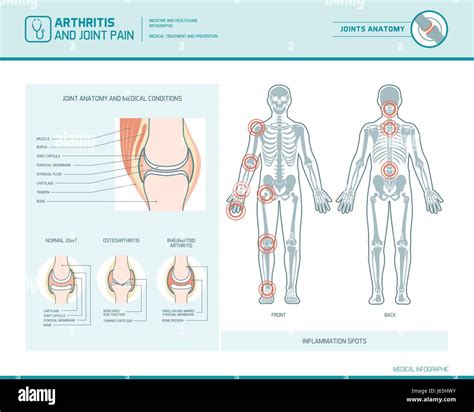 Rheumatoid Arthritis Osteoarthritis And Joint Pain Infographic With