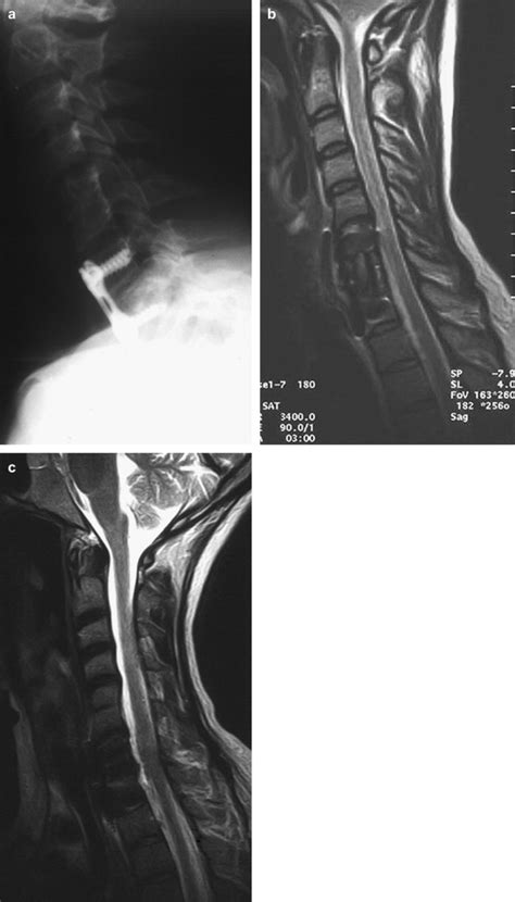 Excision Of An Asymptomatic Cervical Intradural Neurenteric Cyst
