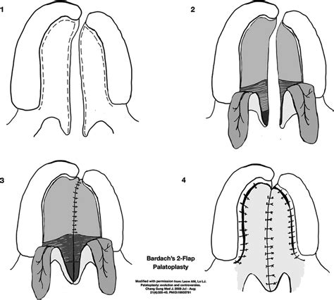 Bardachs Two Flap Palatoplasty Technique Drawn By The First Author