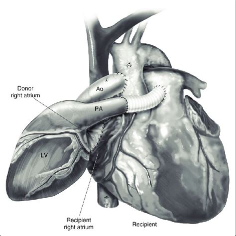 Heterotopic Heart Transplantation Source Reprinted From Copeland Et