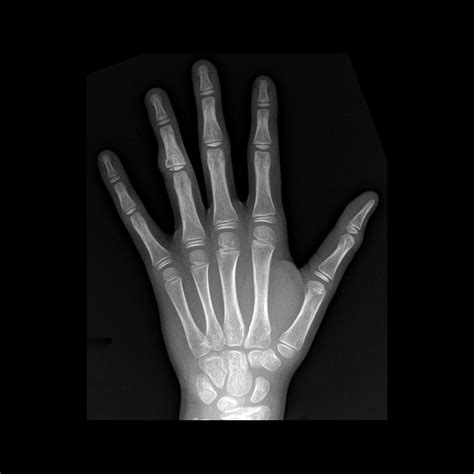 Salter Harris Type Iv Fracture Pacs