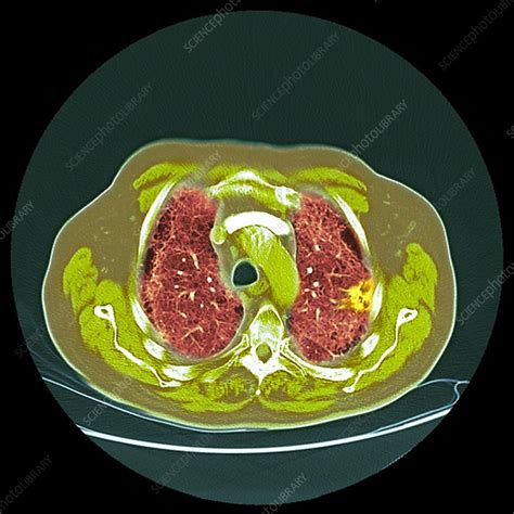 Lung Cancer Ct Scan Stock Image F0121361 Science Photo Library
