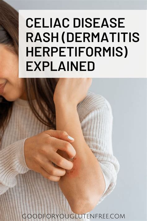 Celiac Disease Rash Dermatitis Herpetiformis Explained In 2021