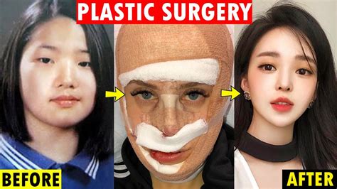 Korean Artist Plastic Surgery Before And After