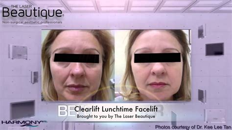 Clearlift Lunchtime Facelift Youtube