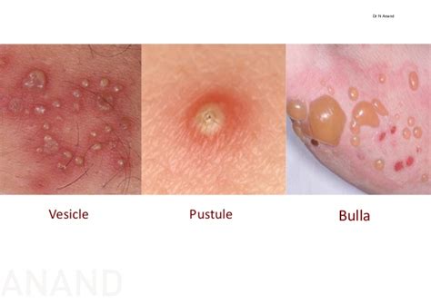 Hives are raised, itchy skin welts. rash with pustules - pictures, photos