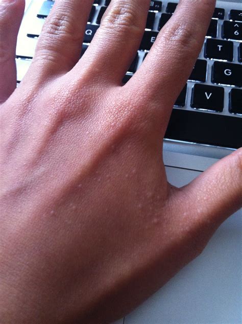 Most Popular Youtube Names Tumblr Itchy Bumps On Hands Nhs