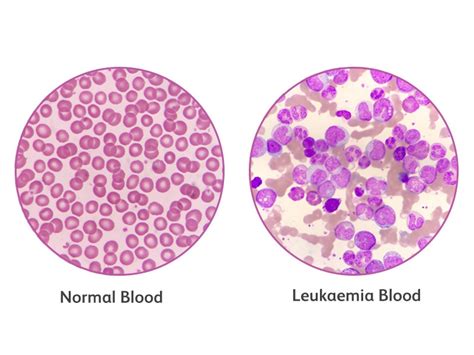 Leukemia Cells With Labels
