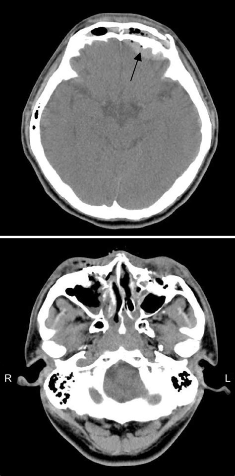 The Finding Of Brain Ct Scanning L Epidural Hematoma Over Left