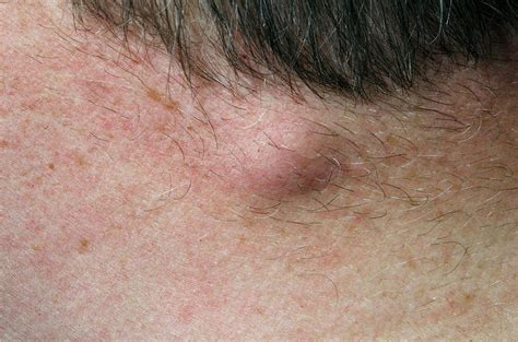 Sebaceous Cyst On The Neck Photograph By Dr P Marazziscience Photo