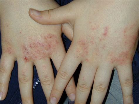 Dermatita Atopica La Copii Cauze Simptome Tratament Copilul Ro Hot