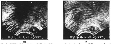 Pdf Transrectal Ultrasonography Of A Small Rectal Carcinoid Tumor