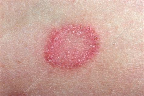 Skin Fungal Infection Pictures Superficial Fungal Infection Ringworm