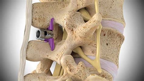 Vertiflex Anesis Spine And Pain Care