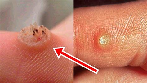 Maybe you would like to learn more about one of these? Cheapest Way To Remove Warts