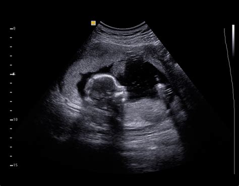 Ultrasound Gambaran