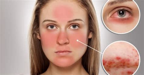 The Four Stages Of Rosacea Skin Care