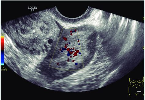 Ovarian Mass In Ultrasound Download Scientific Diagram