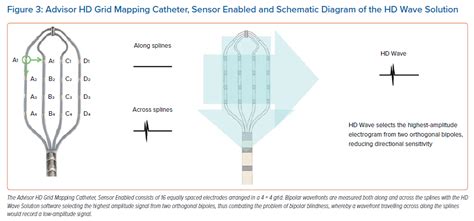 Advisor Hd Grid Mapping Catheter Sensor Enabled And Schematic Diagram