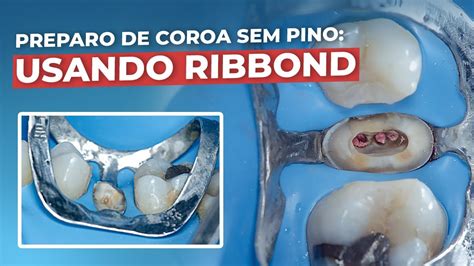 Coroa Provisória Sem Pino