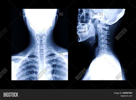 X Ray C Spine X Ray Image And Photo Free Trial Bigstock