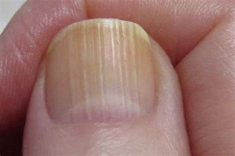 Deep Vertical Ridges In Fingernails Design Talk