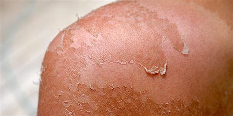 How Long Sunburn Lasts And How To Speed Up The Healing Process