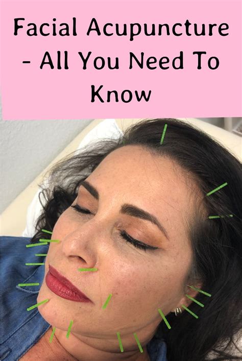 All You Need To Know About Facial Acupuncture Acupuncture Facial