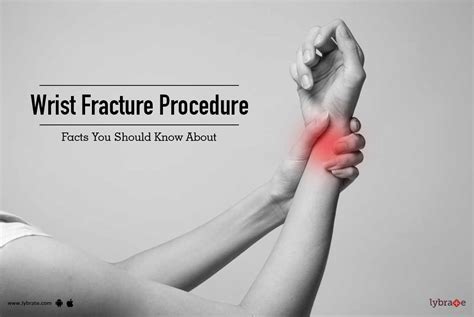 Wrist Fracture Procedure - Facts You Should Know About ...