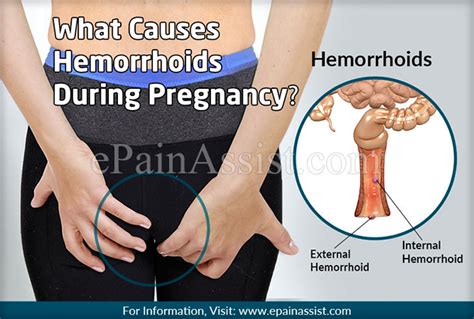 What Causes Hemorrhoids During Pregnancy And Know Its Prevention And Treatment