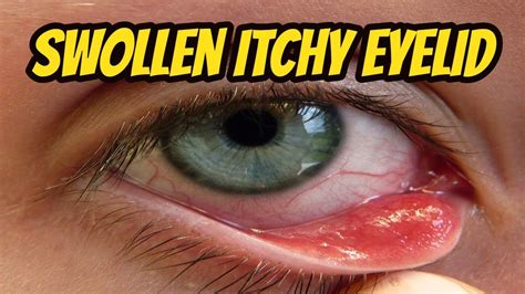 Itchy Rash On Eyelid Swollen
