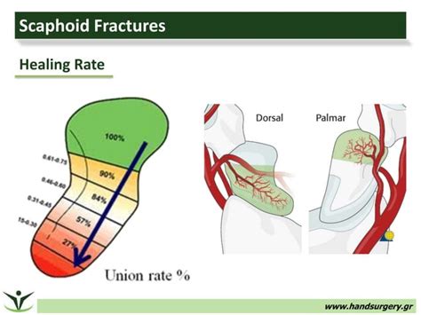 Arthroscopic Treatment Of Scaphoid Fractures And Nonunions
