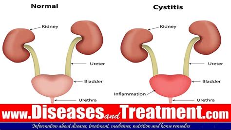 Bladder Infection Cystitis Causes Symptoms Diagnosis Treatment