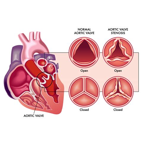 Heart Valve Disease