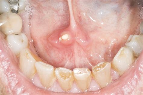 What You Need To Know About Salivary Gland Stones Uganda Dental