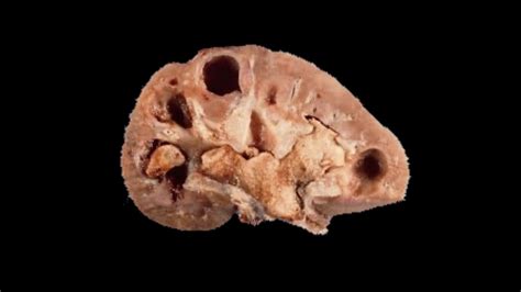 What Causes Kidney Stones Aka Renal Lithiasisa Pathophysiology