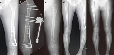 Chipping Corrective Osteotomy For Reconstruction Of Malunion With
