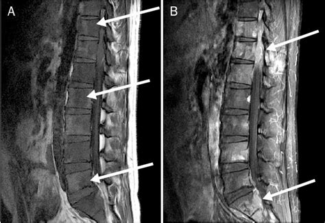 Mri Findings Of Thoracolumbar Spine A T1 Weighted Image Showed