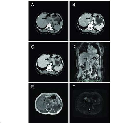 Abdominal Ct And Mri Findings Of The Patient A Plain Ct Scan Revealed