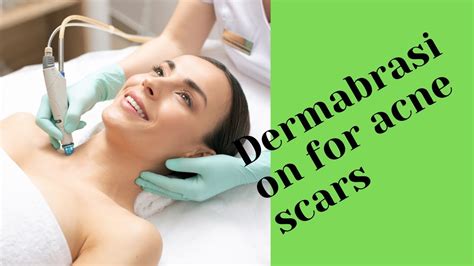 Dermabrasion For Acne Scars Youtube