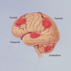 Avm Brain Hemorrhage
